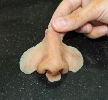 Nasal Prosthesis