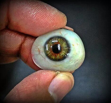 Ocular Prosthesis